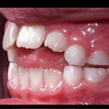 a close up of a person 's mouth with white teeth and red gums .