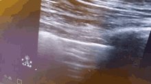 Pneumothorax Lungpoint GIF - Pneumothorax Lungpoint Lung GIFs
