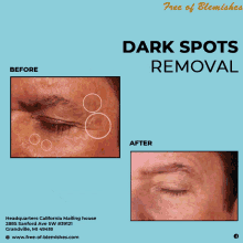Dark Blemishes On Face Permanently Blemish Remover Cream GIF - Dark Blemishes On Face Permanently Blemish Remover Cream GIFs