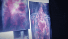 an x-ray of a heart is displayed on a monitor