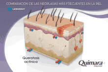 Quimara Piel GIF - Quimara Piel Neoplasia GIFs