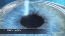 近視雷射prk-lasik-eye Surgery GIF