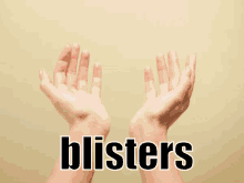 Blister GIF - Blister Hand Blister Ouch GIFs