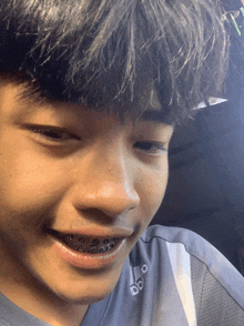 a young man with braces on his teeth is wearing a shirt that says adidas
