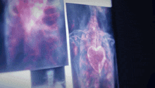 an x-ray of a heart is shown on a screen