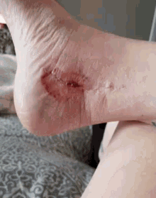 Foot Wound GIF - Foot Wound GIFs