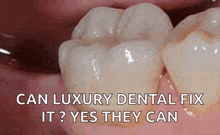 Fixed Dentures Flexible Dentures GIF - Fixed Dentures Flexible Dentures Metal Dentures GIFs