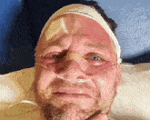 a man with a bandage on his head and an oxygen tube in his mouth