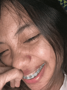 a girl with braces on her teeth is smiling and touching her face