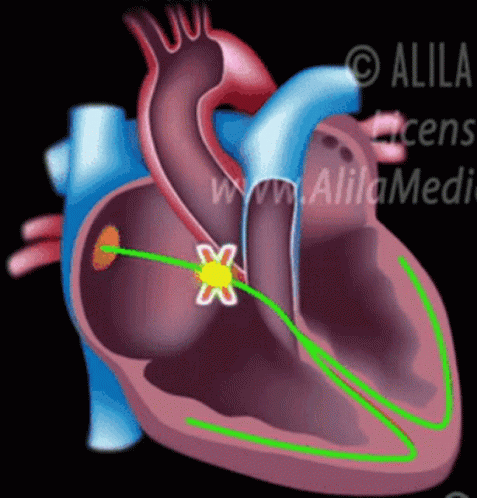 Av Conduction Blocks Heart GIF - AV Conduction Blocks Heart Animation -  Discover & Share GIFs