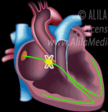 Av Conduction Blocks Heart GIF - Av Conduction Blocks Heart Animation GIFs