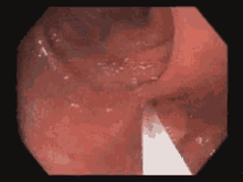 Polyp Throat GIF - Polyp Throat GIFs