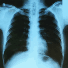 Xray Heart GIF - Xray Heart Lungs GIFs