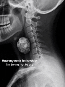 an x-ray of a person 's neck with the words how my neck feels