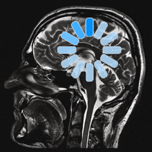 a black and white image of a person 's brain with a blue circle in the middle
