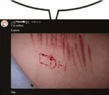 a picture of a person 's skin with the letters dh written on it