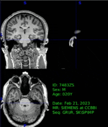Human Brain Mri Gif Brain Mri GIF - Human Brain Mri Gif Brain Mri Brain Mri Gif GIFs