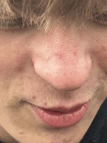 a close up of a person 's face with a red spot on his nose