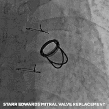 starr edwards mechanical valve cardiology thoracic surgery